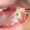 Dental-Cavity-scaled