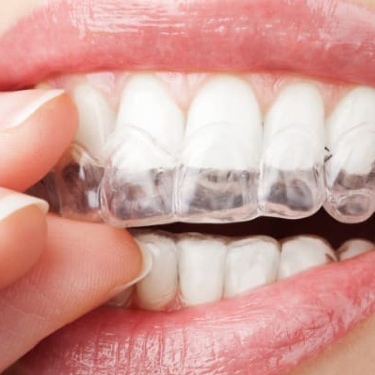 bruxismo-tratamiento-clinica-dental