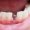 implante-dental-rechazo-clinica-dental-barcelona