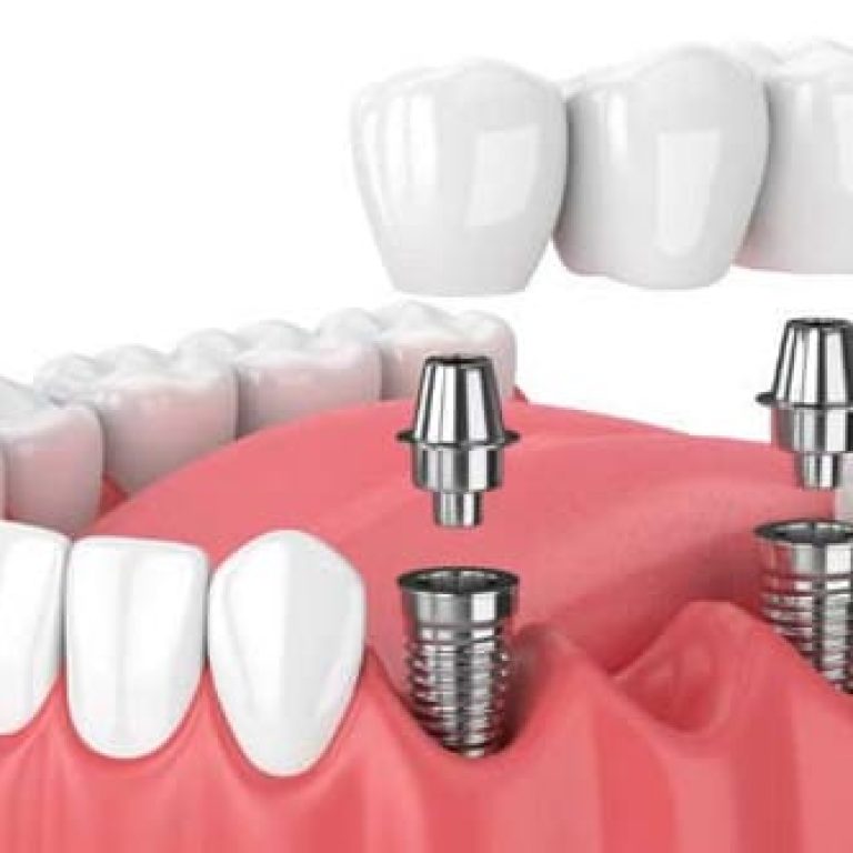 implantes-de-carga-inmediata-el-eixample-barcelona